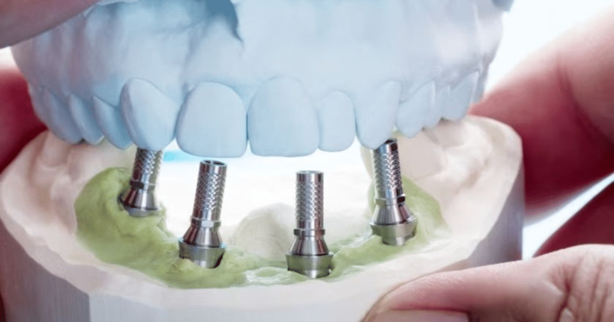 all-on-4-dental-implants- a comprehensive guide