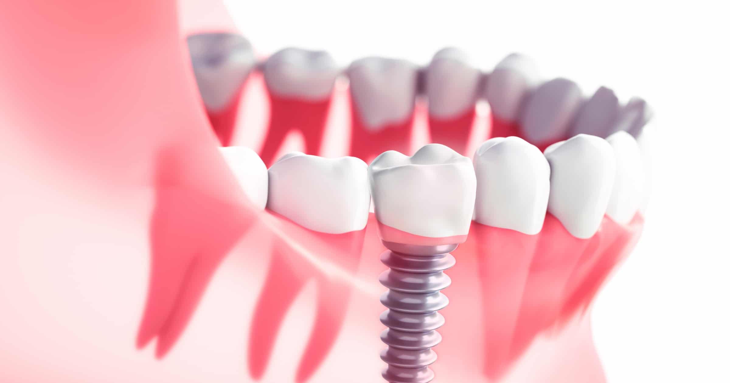 dental implant infection results